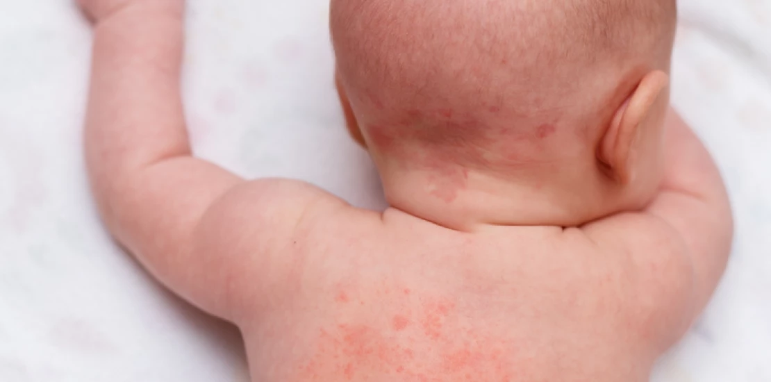 Причини свербіжу при алергії у дитини