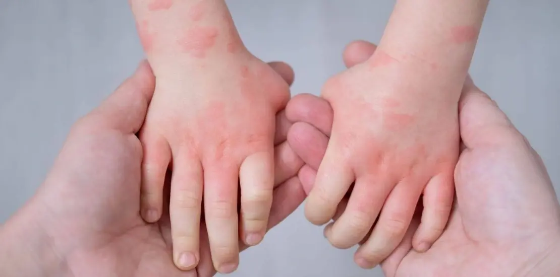 Кропив’янка у дітей: причини, симптоми та лікування