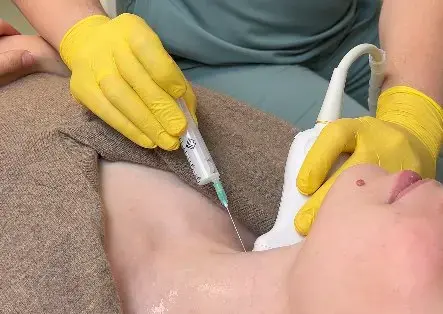 Тонкоголкова аспіраційна пункційна біопсія щитоподібної залози під контролем УЗД