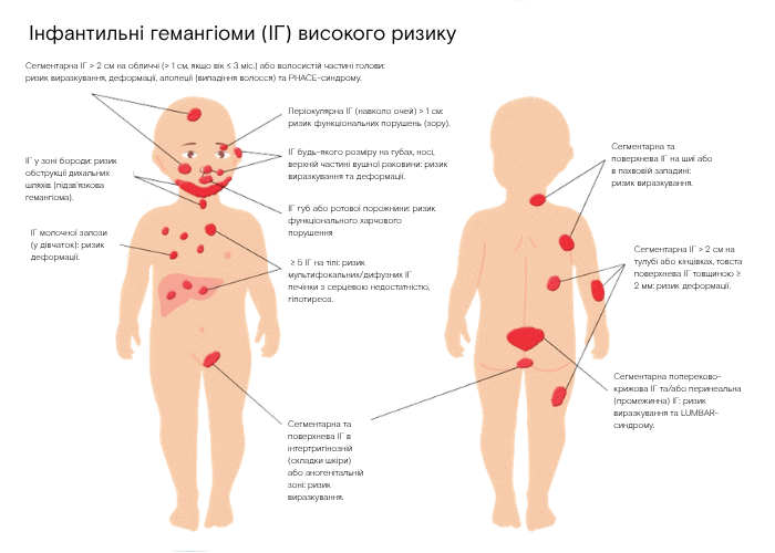 Інфографіка інфантильних гемангіом високого ризику: локалізації та можливі ускладнення (виразкування, деформації, порушення зору)