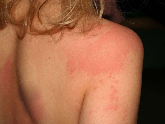 Шкірні прояви дитячої кропив'янки: алергічна висипка, що нагадує кропив'яний опік.