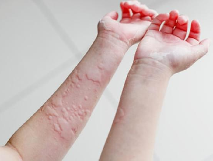 Дитина з ознаками кропив'янки: на шкірі видно червоні плями та пухирці, що нагадують опік кропивою.